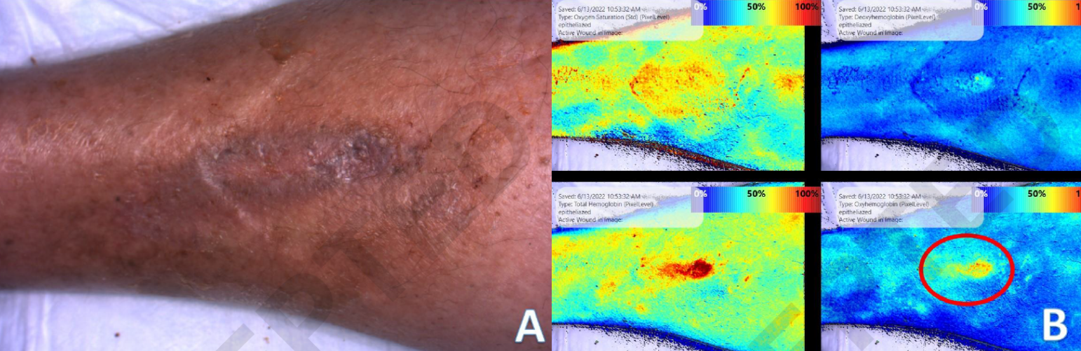 Redefining Wound Healing Using Near-Infrared Spectroscopy — Kent